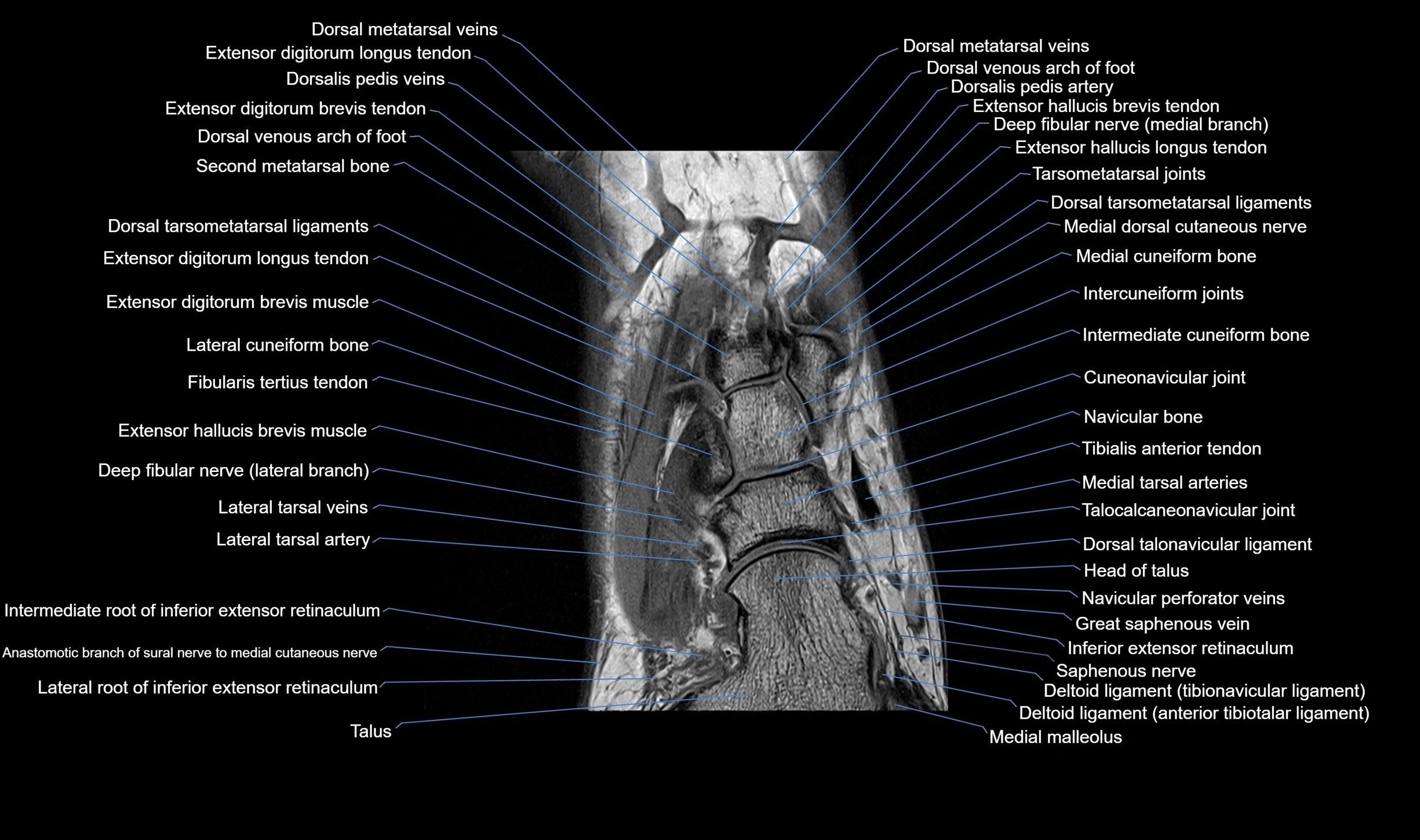 MRI mid foot coronal ligaments cross sectional anatomy 3T  radiology  image-img-00001-00014.webp